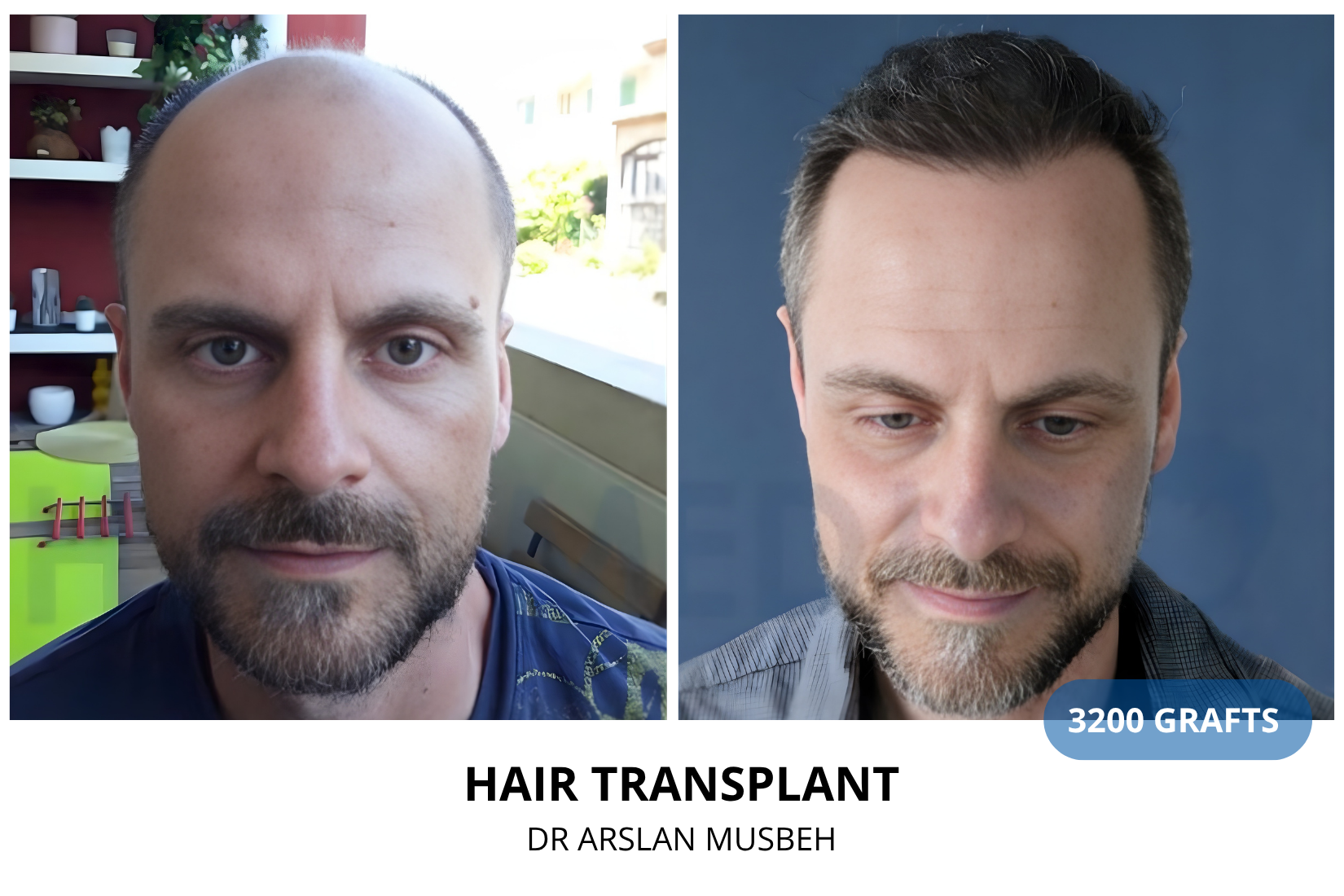 Hair Transplant result, 3200 grafts by Dr. Arslan Musbeh