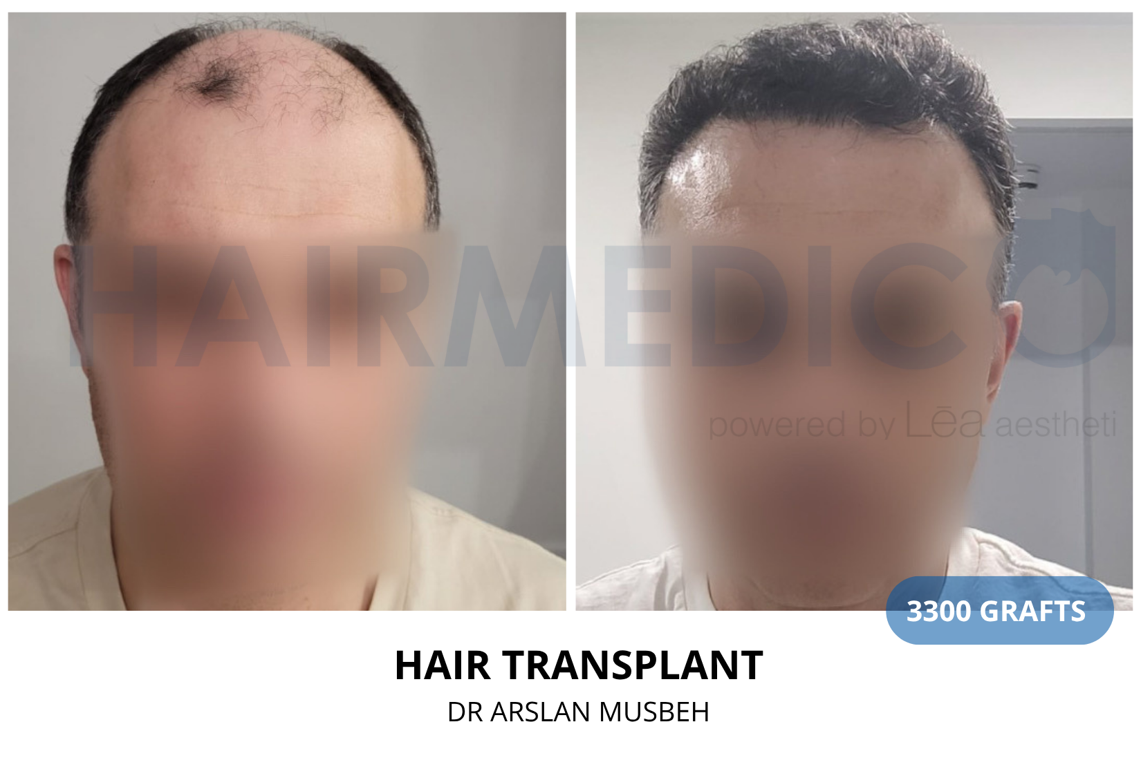 Hair Transplant result, 3300 grafts by Dr. Arslan Musbeh