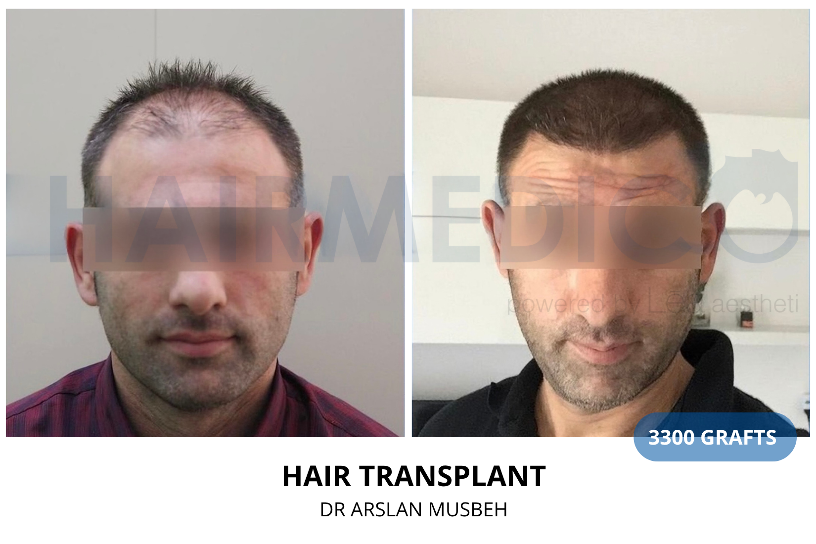 Hair Transplant result, 3300 grafts by Dr. Arslan Musbeh