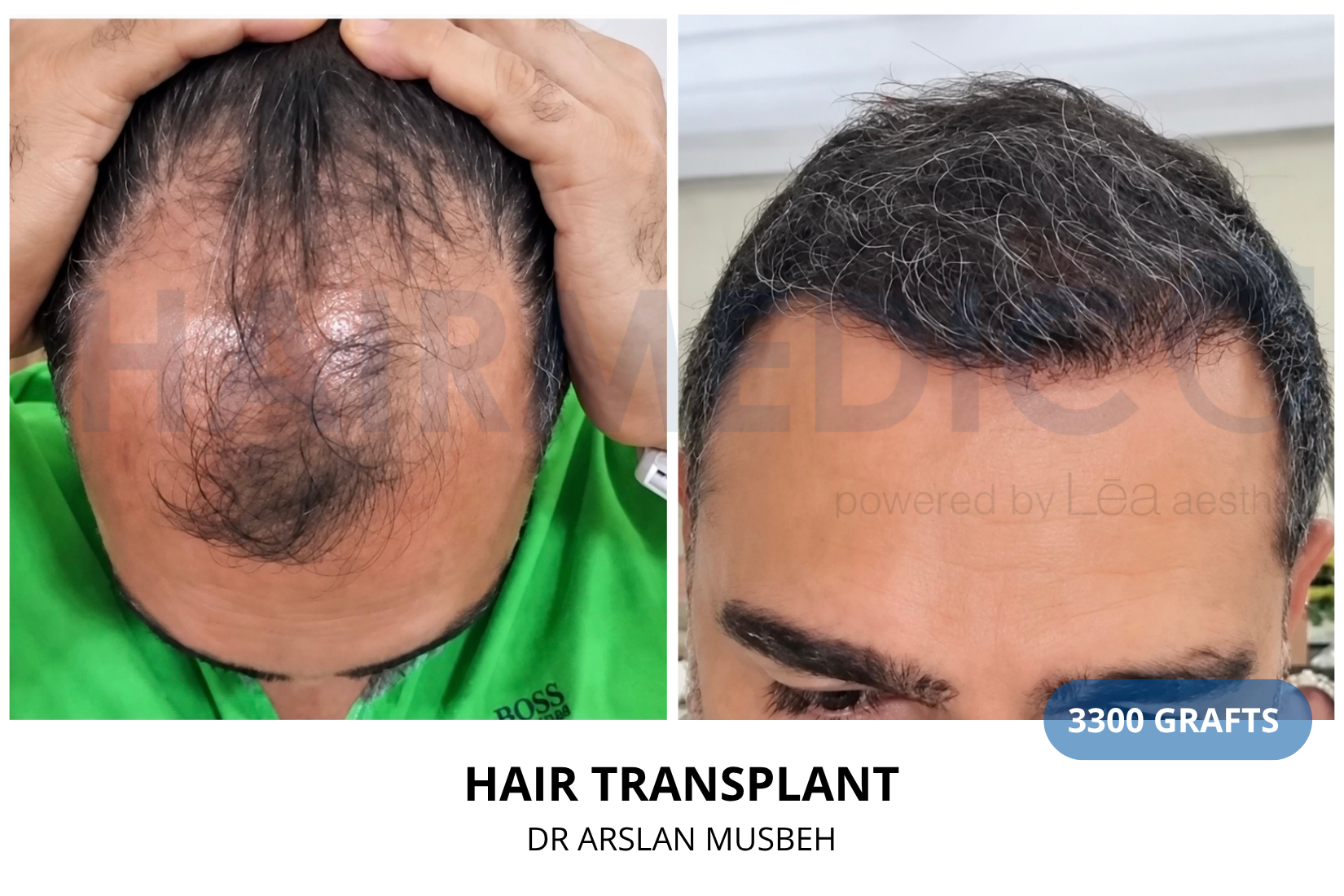 Hair Transplant result, 3300 grafts by Dr. Arslan Musbeh