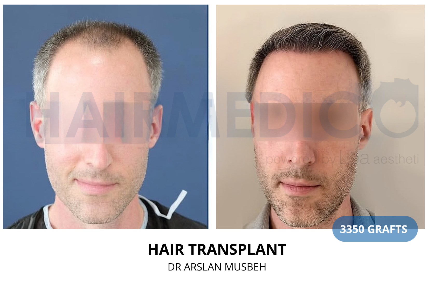 Hair Transplant result, 3350 grafts by Dr. Arslan Musbeh