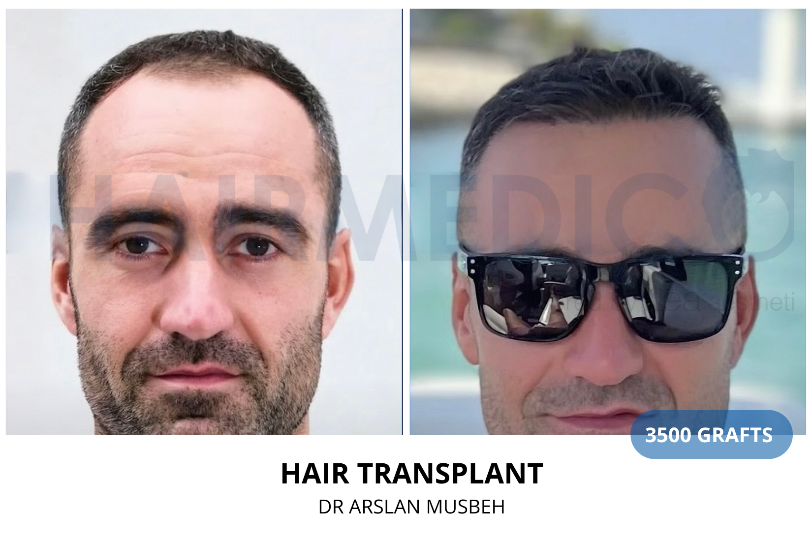 Hair Transplant result, 3500 grafts by Dr. Arslan Musbeh