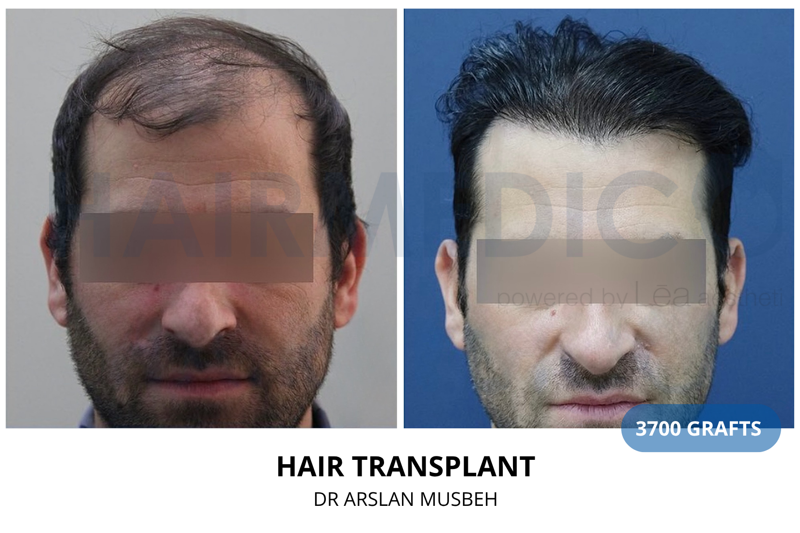 Hair Transplant result, 3700 grafts by Dr. Arslan Musbeh
