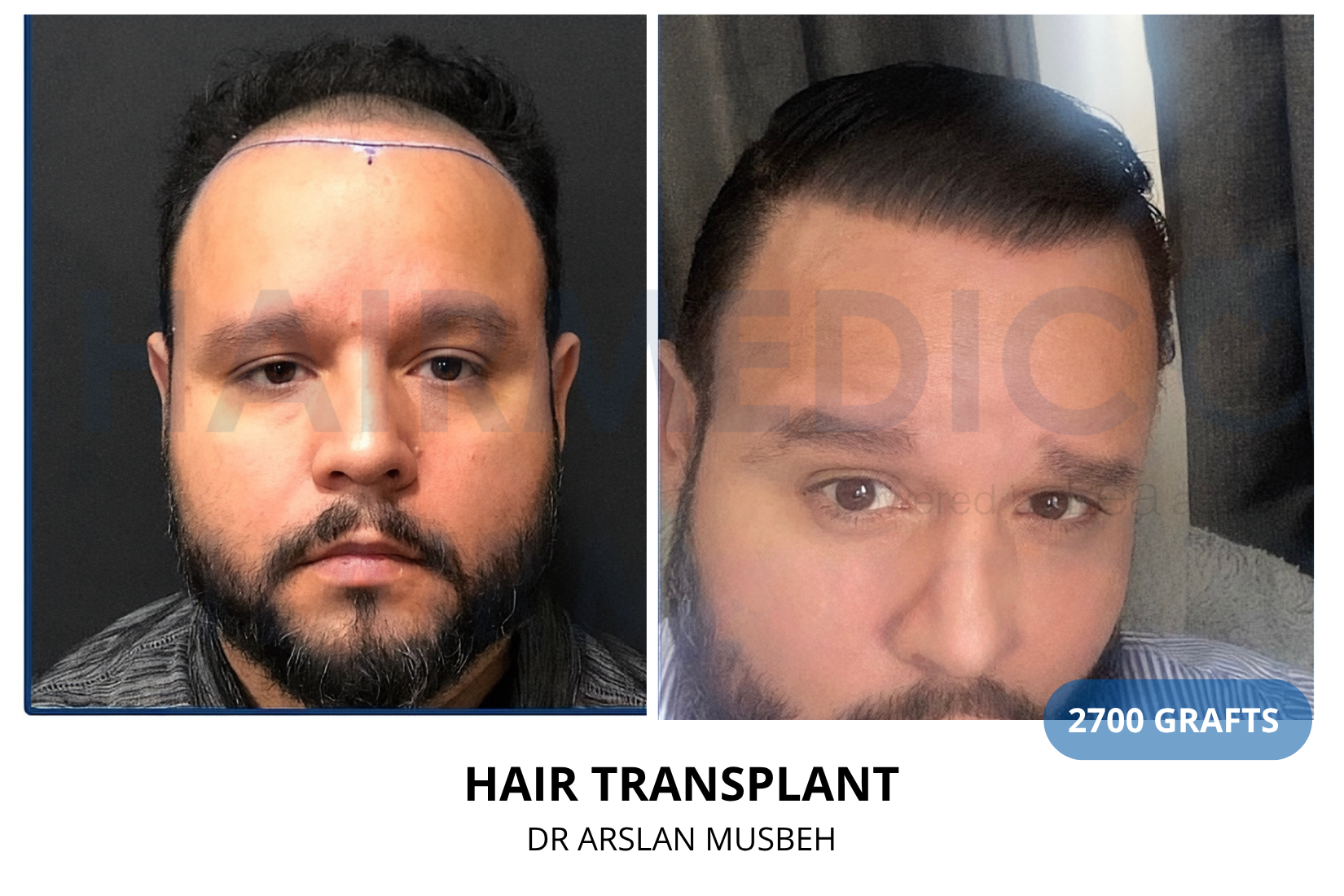 Hair Transplant result, 2700 grafts by Dr. Arslan Musbeh