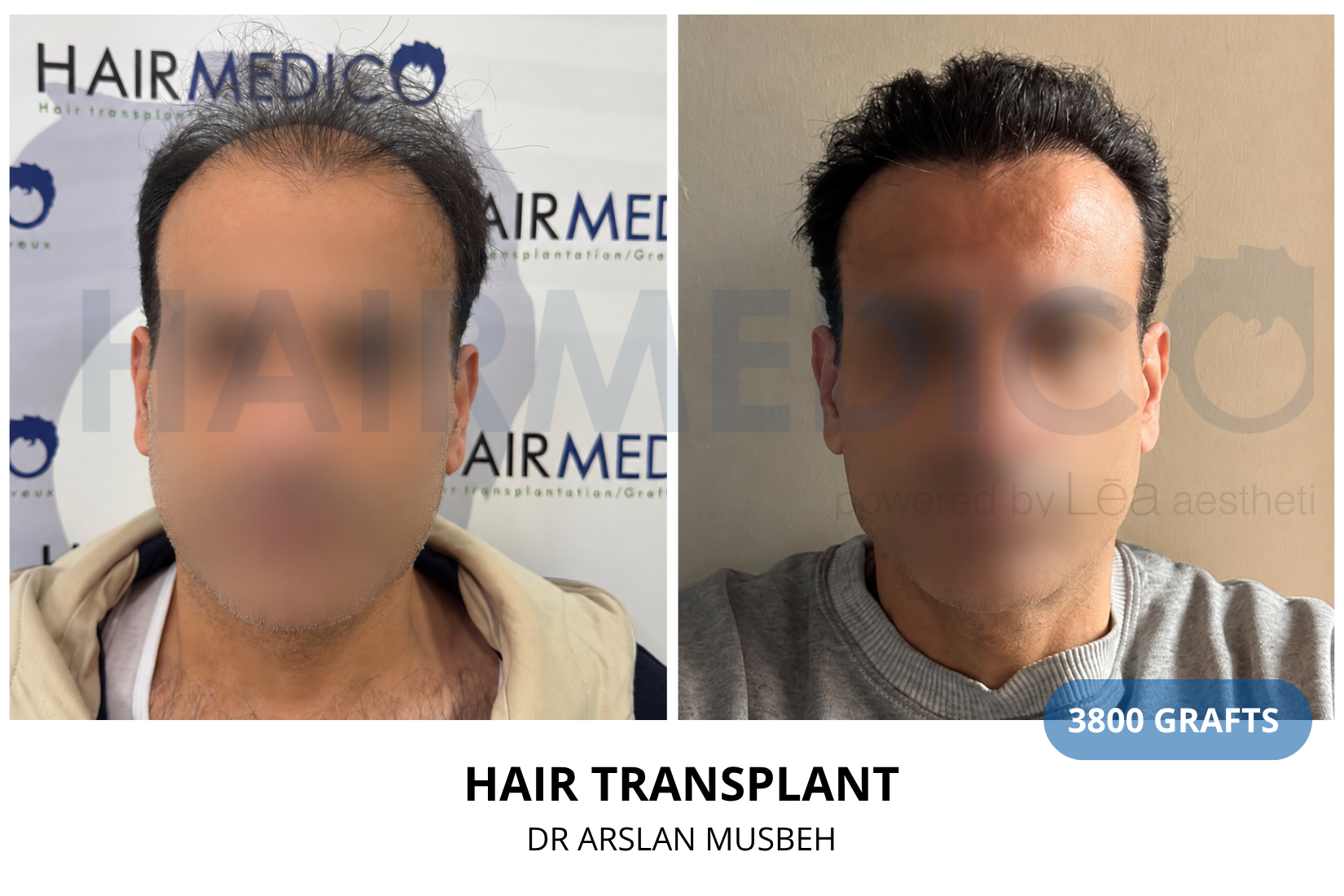 Hair Transplant result, 3800 grafts by Dr. Arslan Musbeh