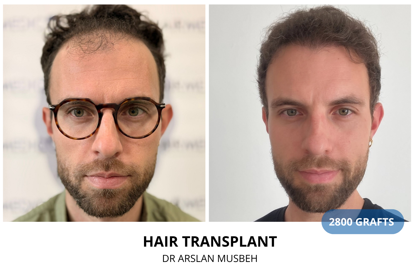 Hair Transplant result, 2800 grafts by Dr. Arslan Musbeh