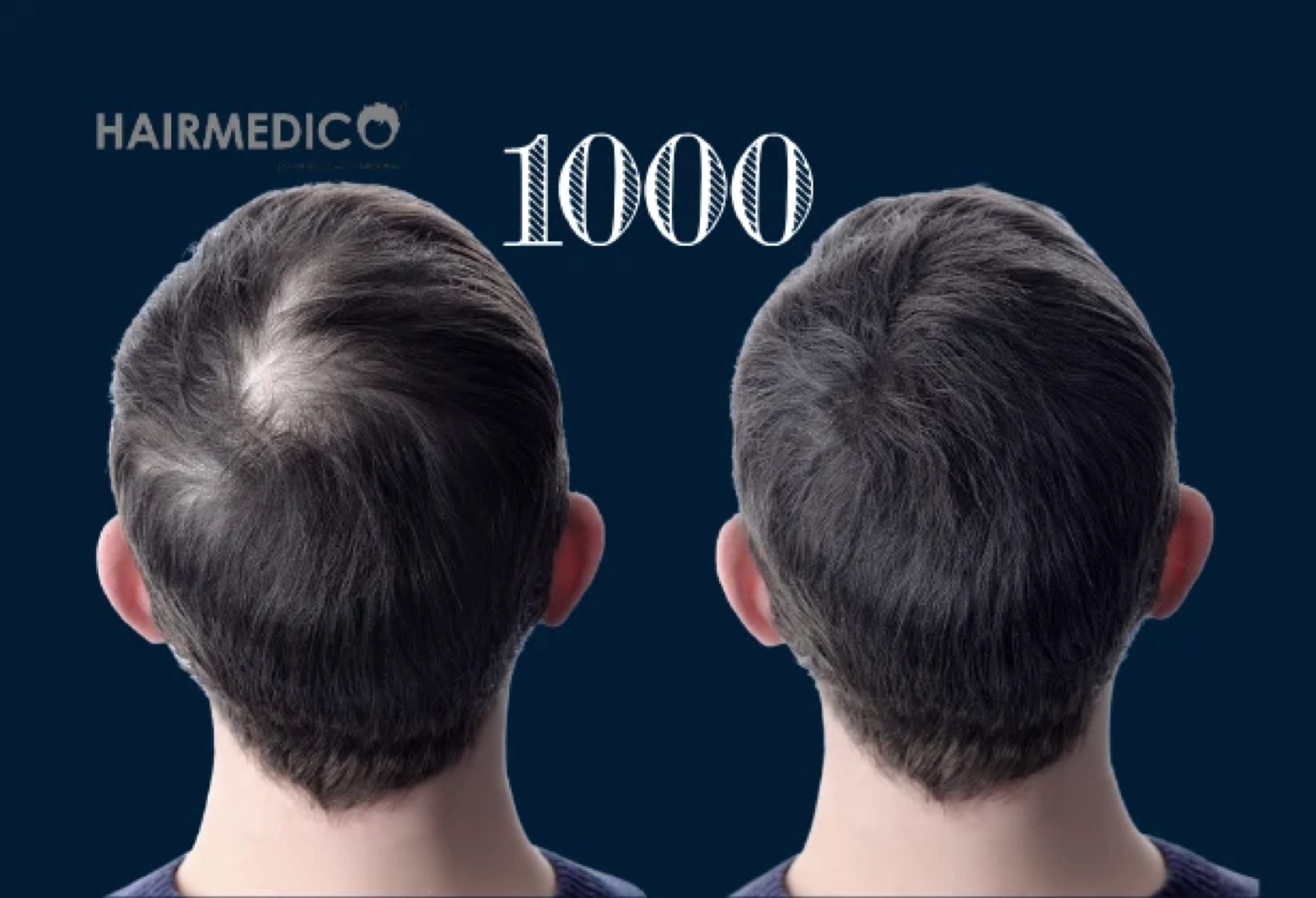 1000 Hair Grafts Before and After 2025