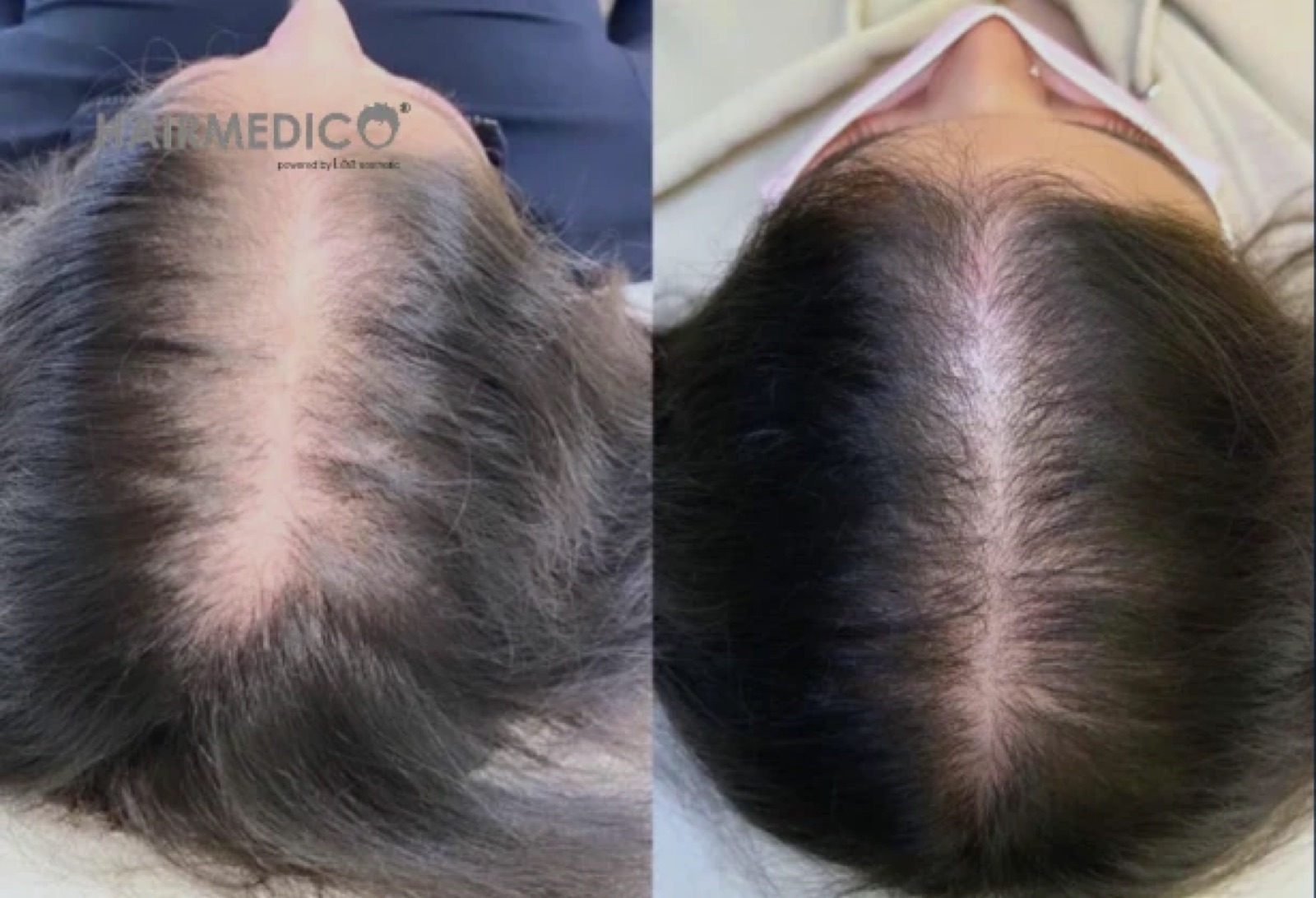3000 Grafts Hair Transplant Before and After 2025