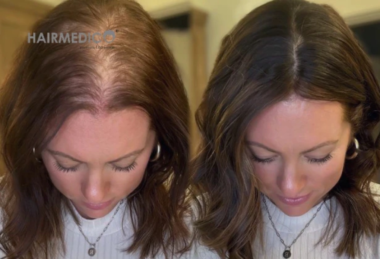 3,500 Grafts Hair Transplant: Before and After Results