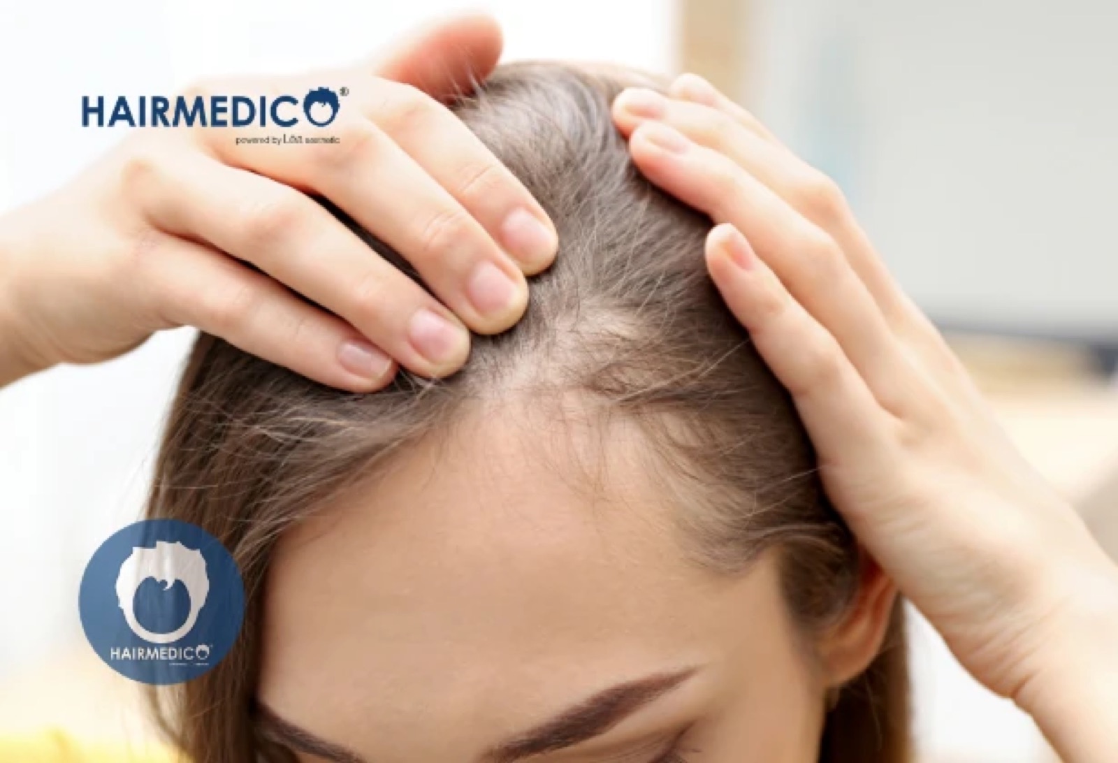 Afro Hair Transplant Post-Op Care for Women