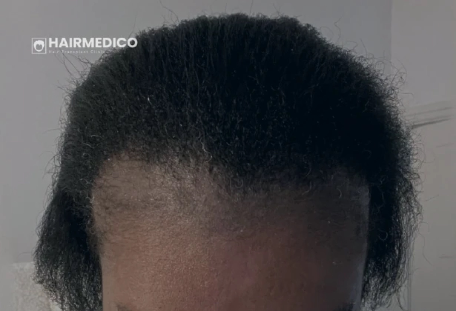 CCCA & Hair Transplant — Central Centrifugal...