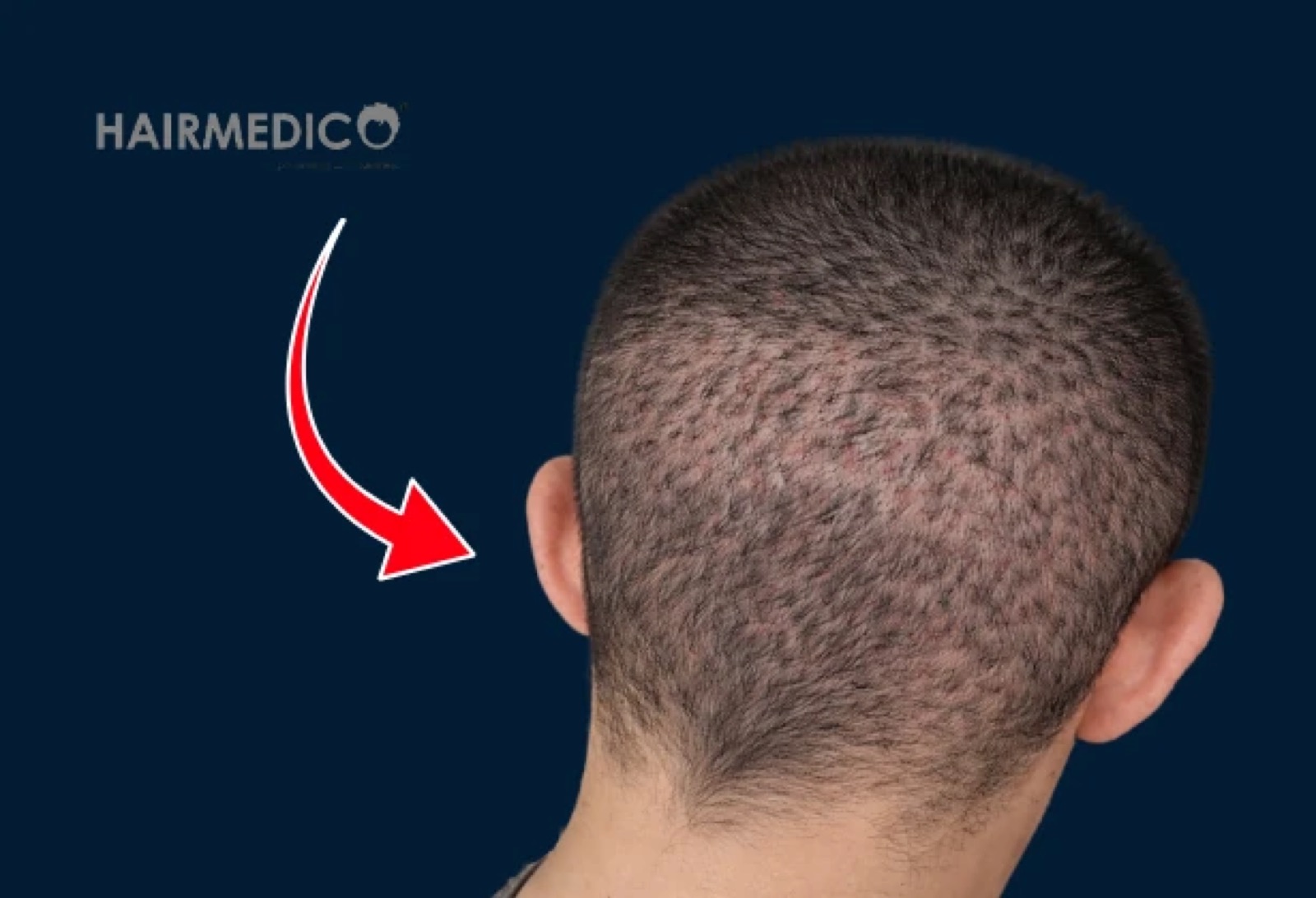 Donor Area Damage — Can Hair Grow Back?