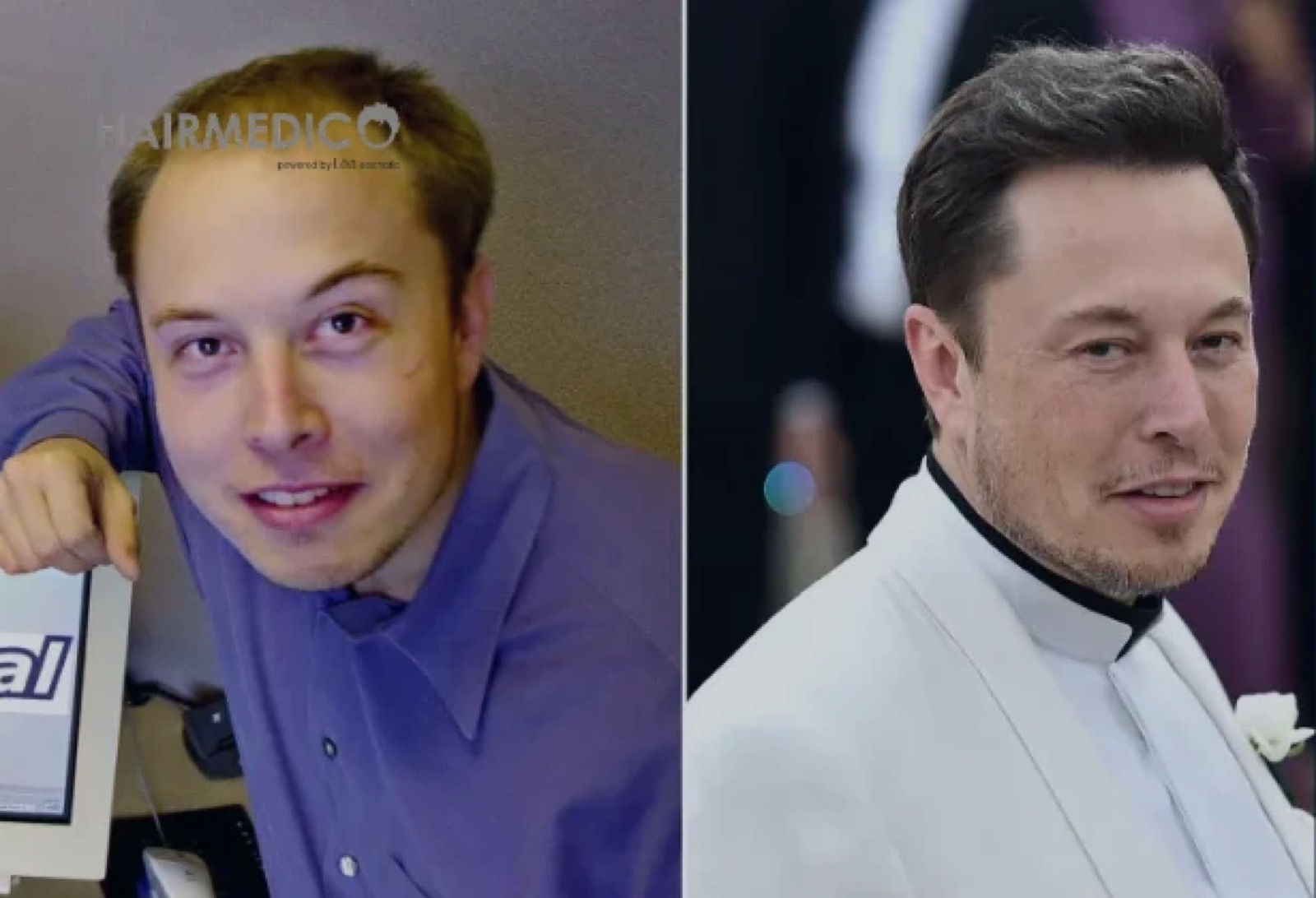 Elon Musk Hair Transplant: What Really Happened?