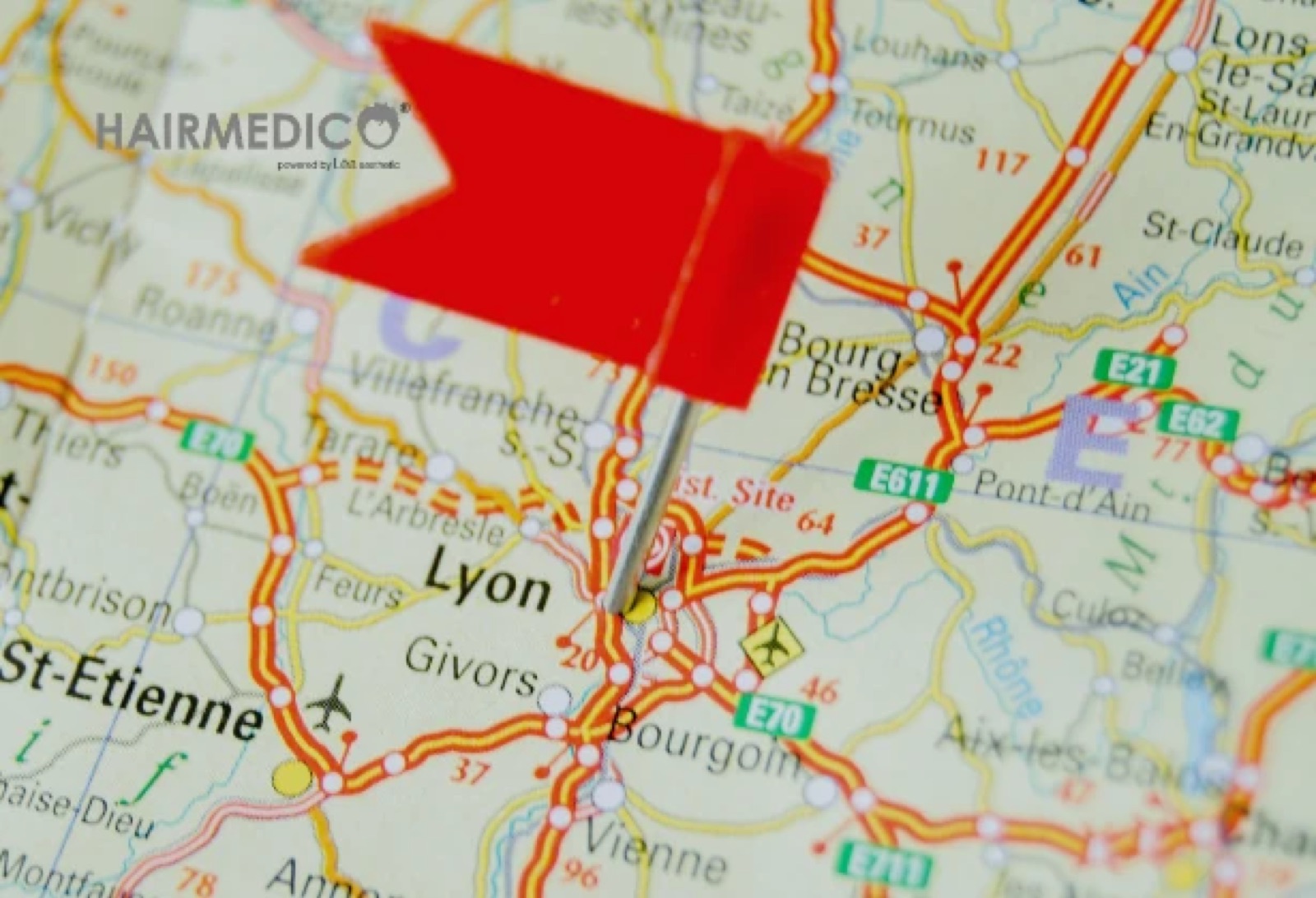 Hair Transplant Lyon — Istanbul vs Local Clinic 2025