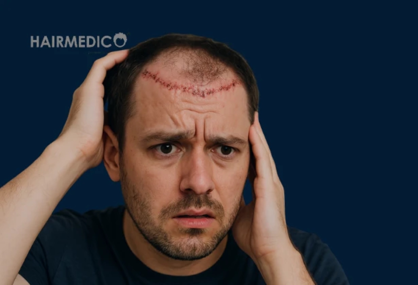 Hair Transplant Gone Wrong: What Causes Bad Results?