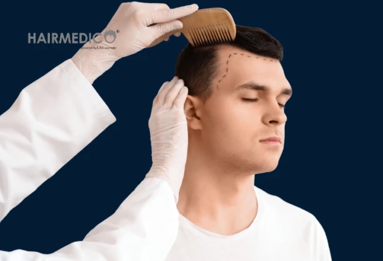 Hair Transplant Methods Explained: FUE, DHI and FUT