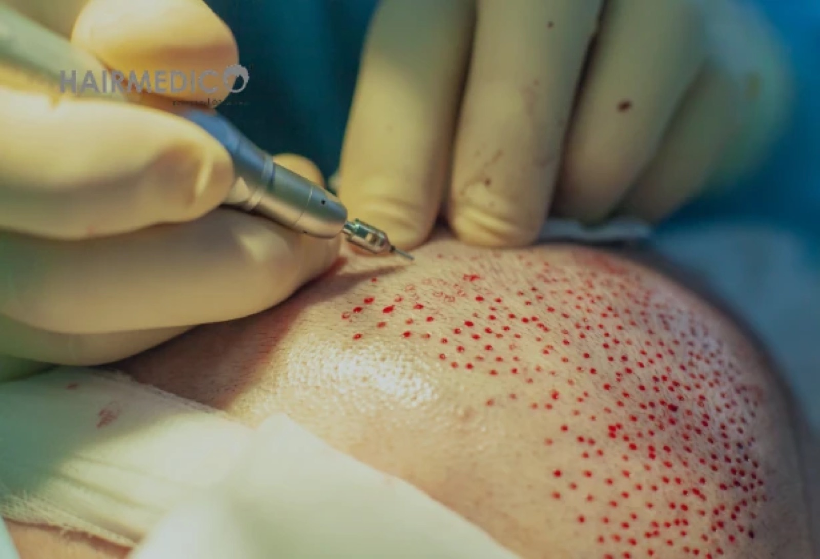 Hair Transplant Packages in Turkey: What's...