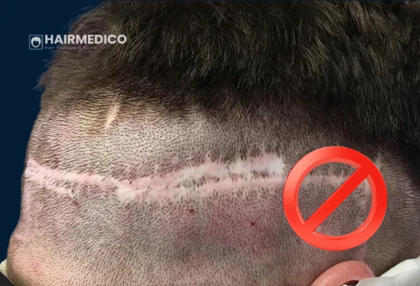 Hair Transplant Repair Surgery — Correcting