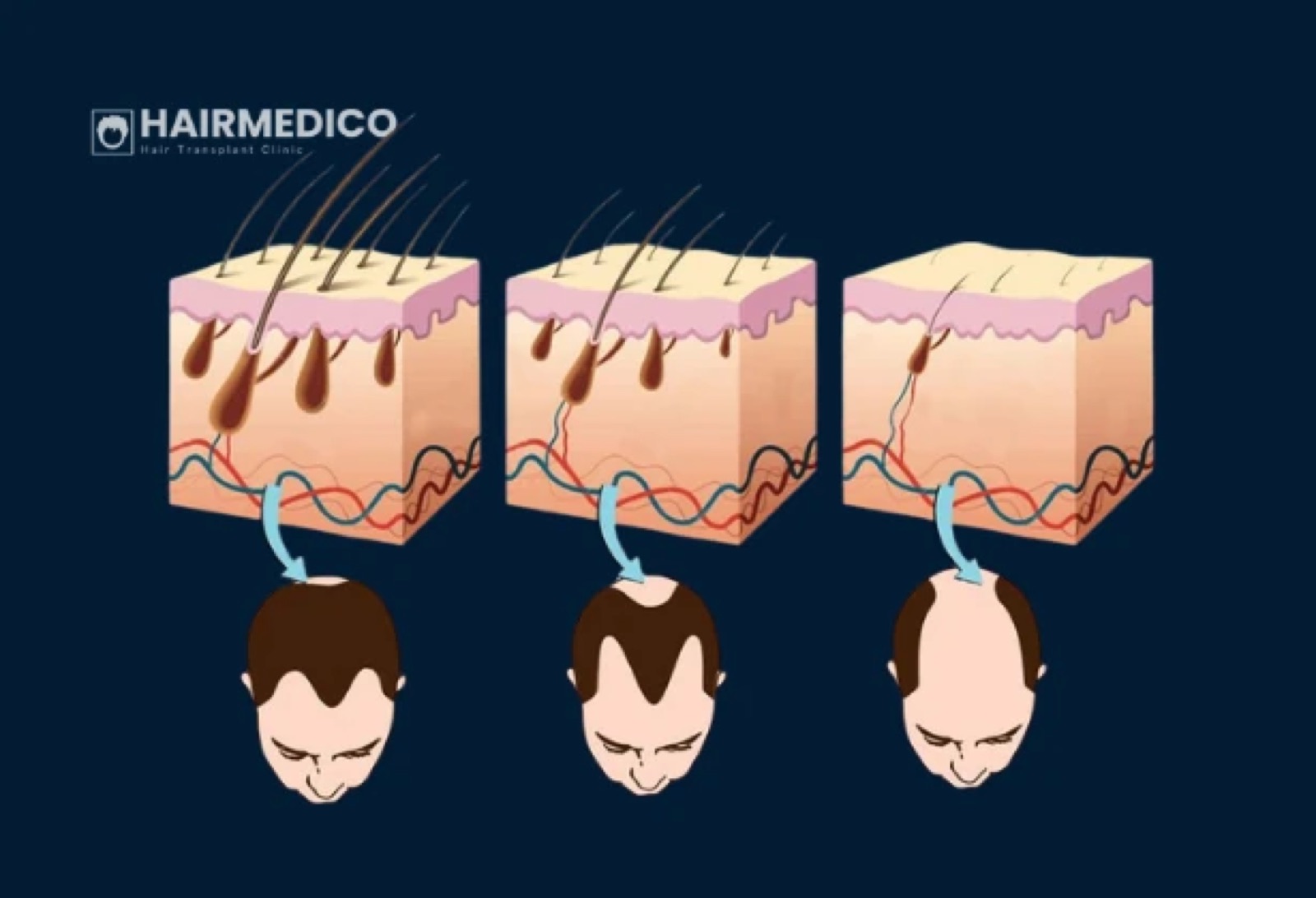 Hair Transplant Success Rate: What the Data...