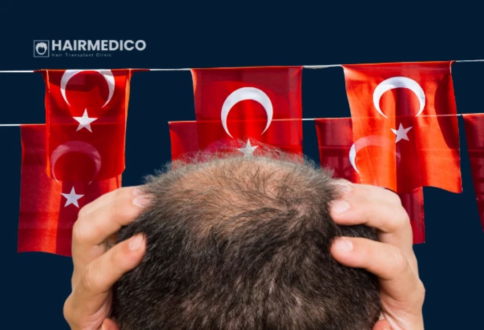 Is Hair Transplant in Turkey Worth It for UK &