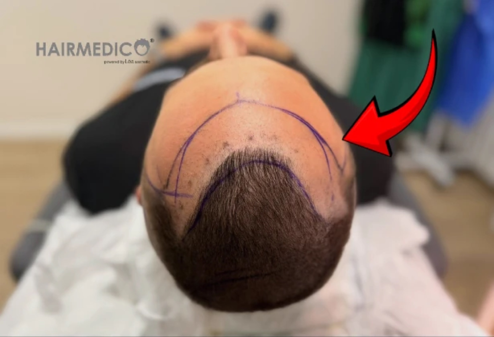 Hairline Design — The Most Important Decision