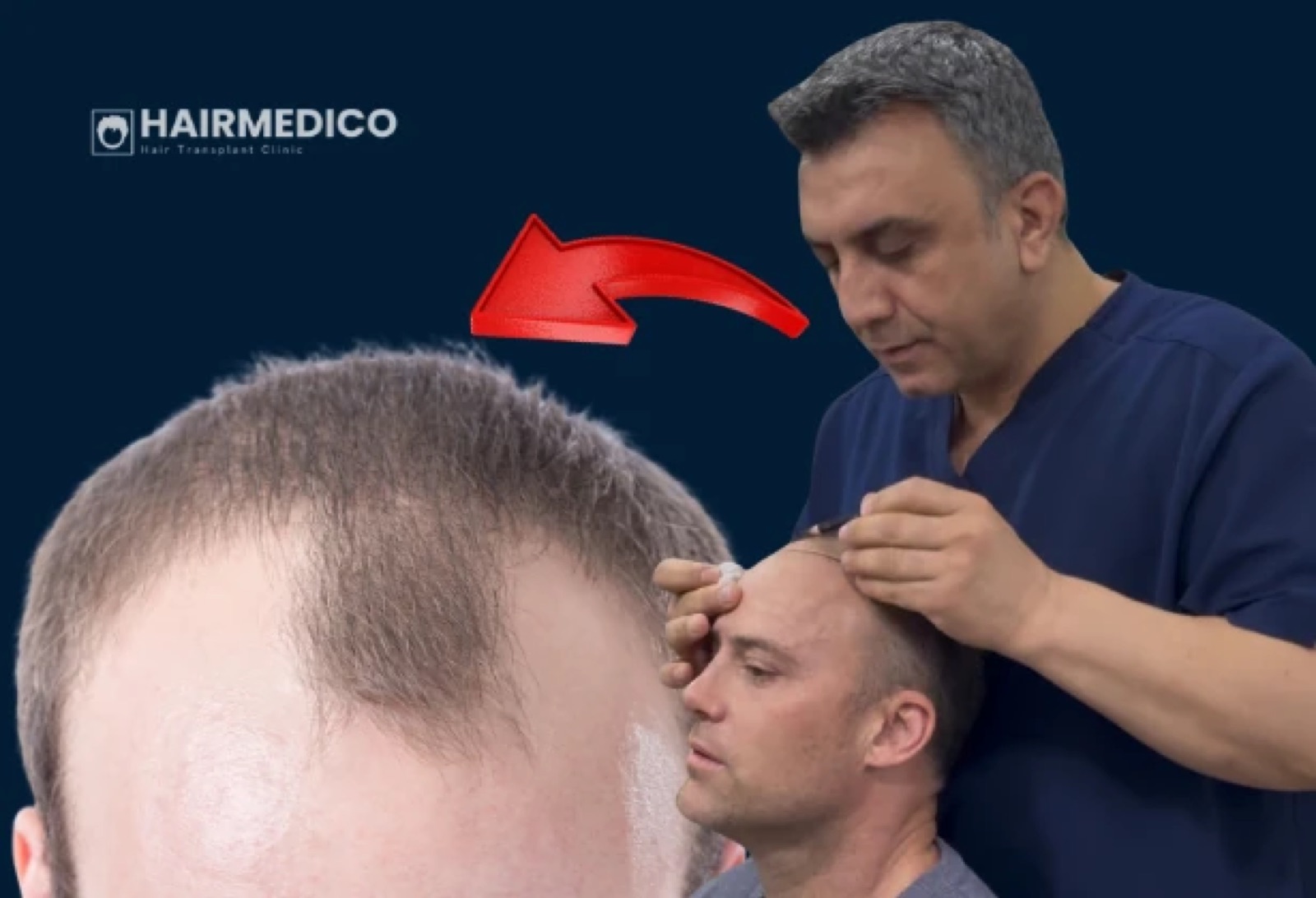 Hairline Design: How Natural Results Are Created