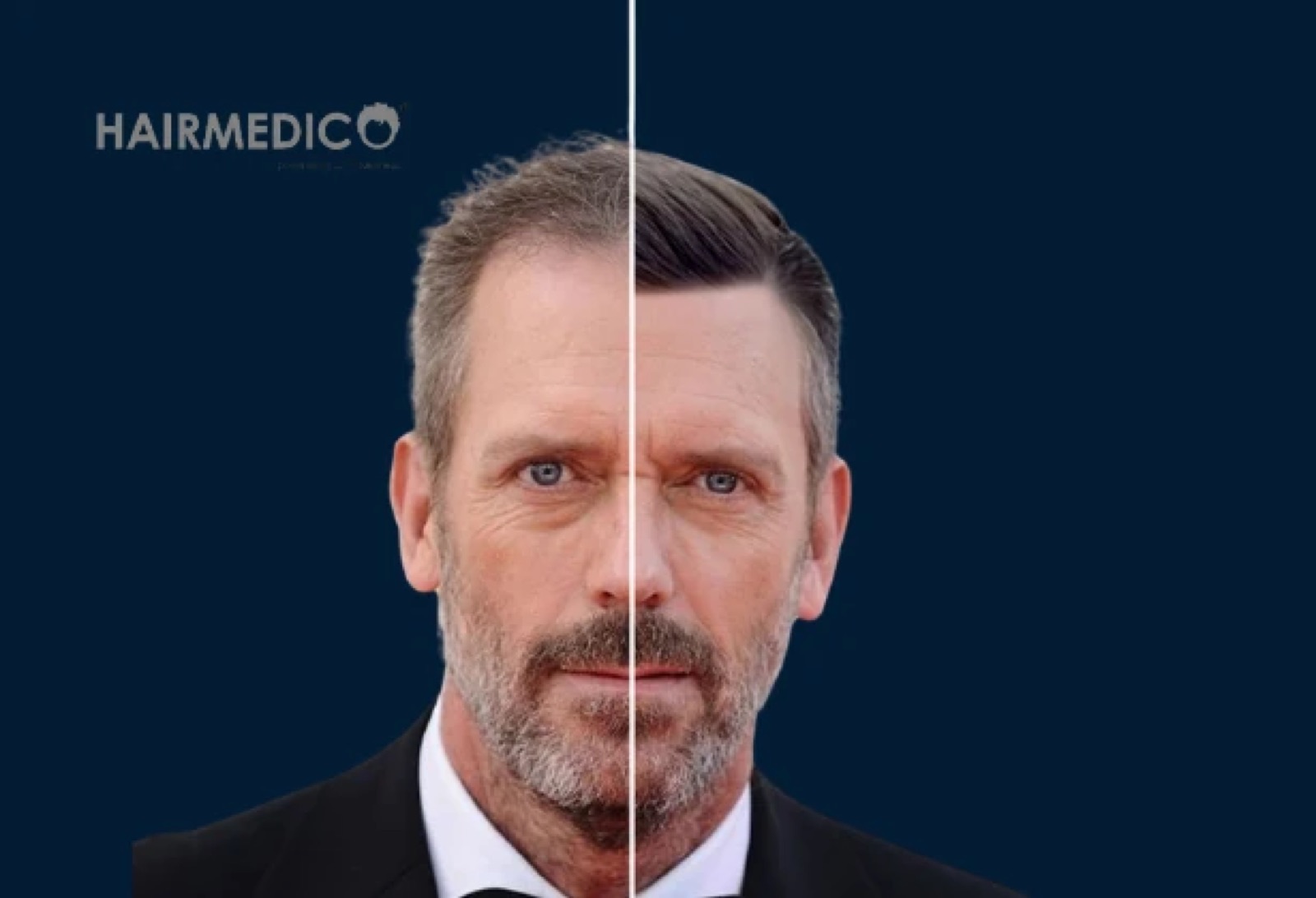 Hugh Laurie Hair Transplant — Analysis and Guide