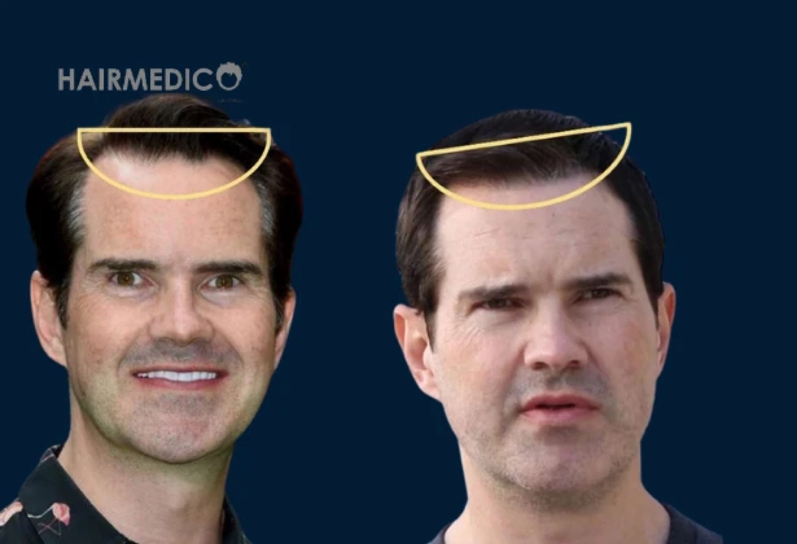 Jimmy Carr Hair Transplant — The Full Story