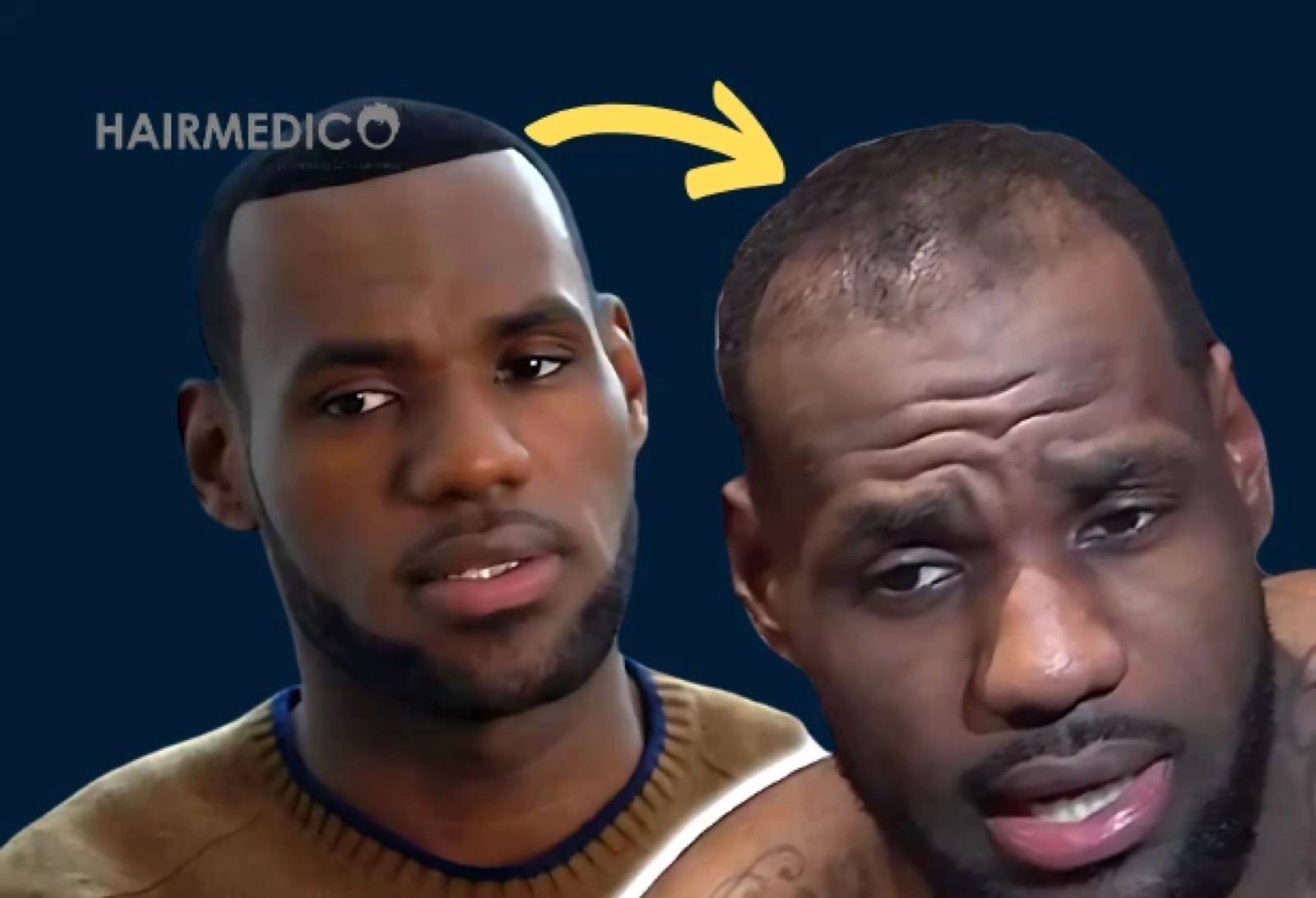 LeBron James Hair Transplant — Did He Get One?