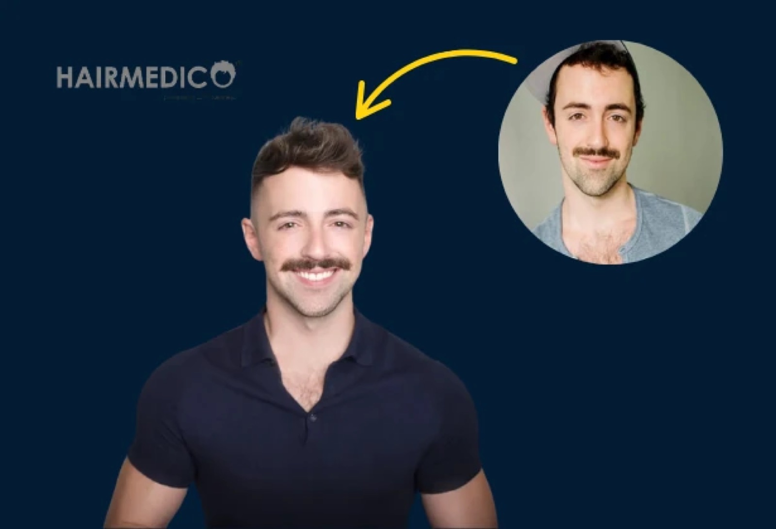 Matteo Lane Hair Transplant — His Journey
