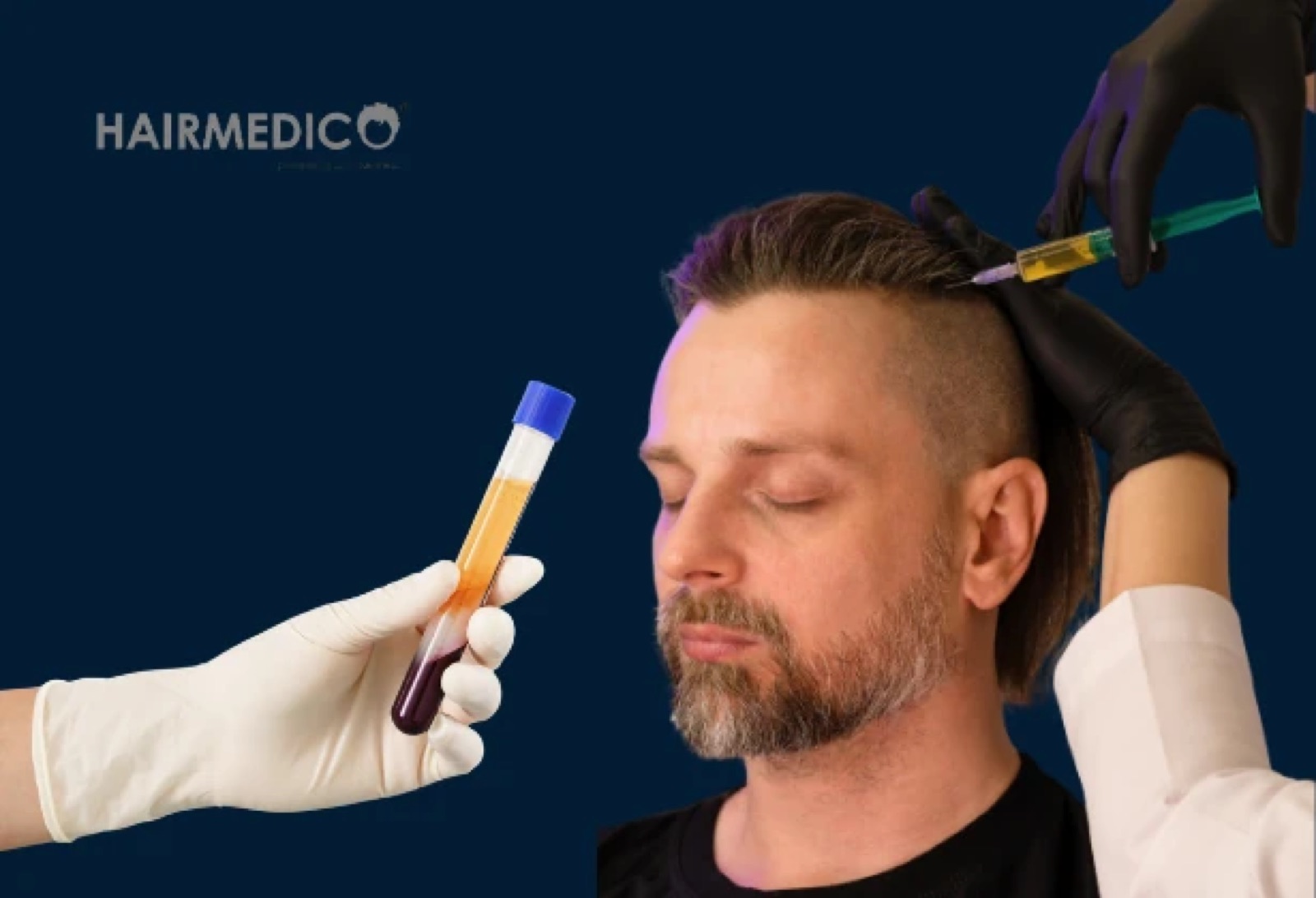 PRP Hair Treatment — Complete Clinical Guide 2026