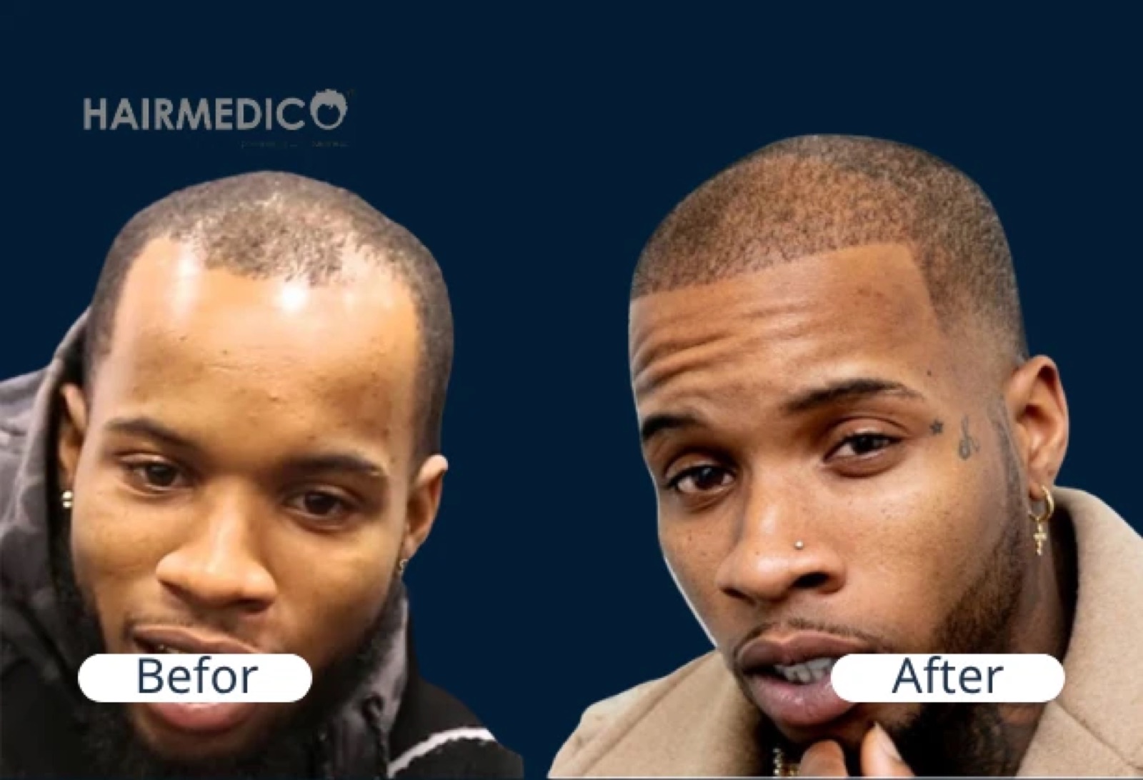Tory Lanez Hair Transplant — Hair Restoration Story