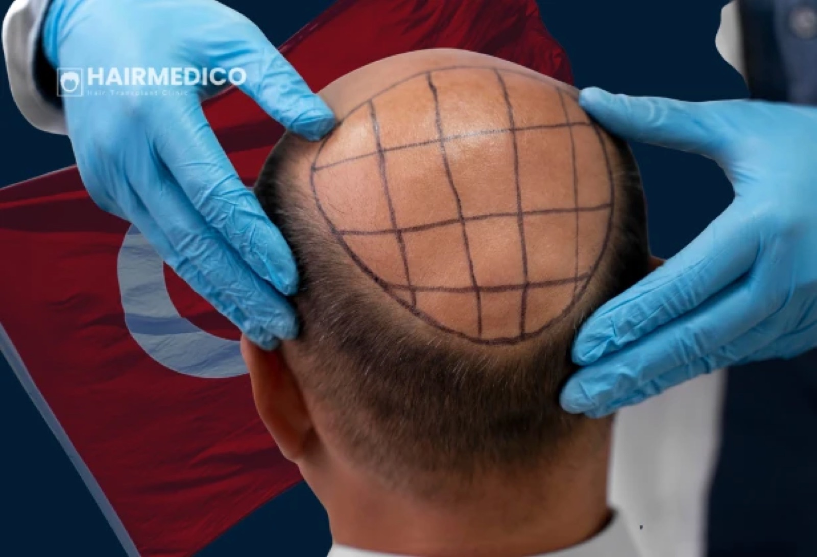 What Is FUE Hair Transplant? Step-by-Step...