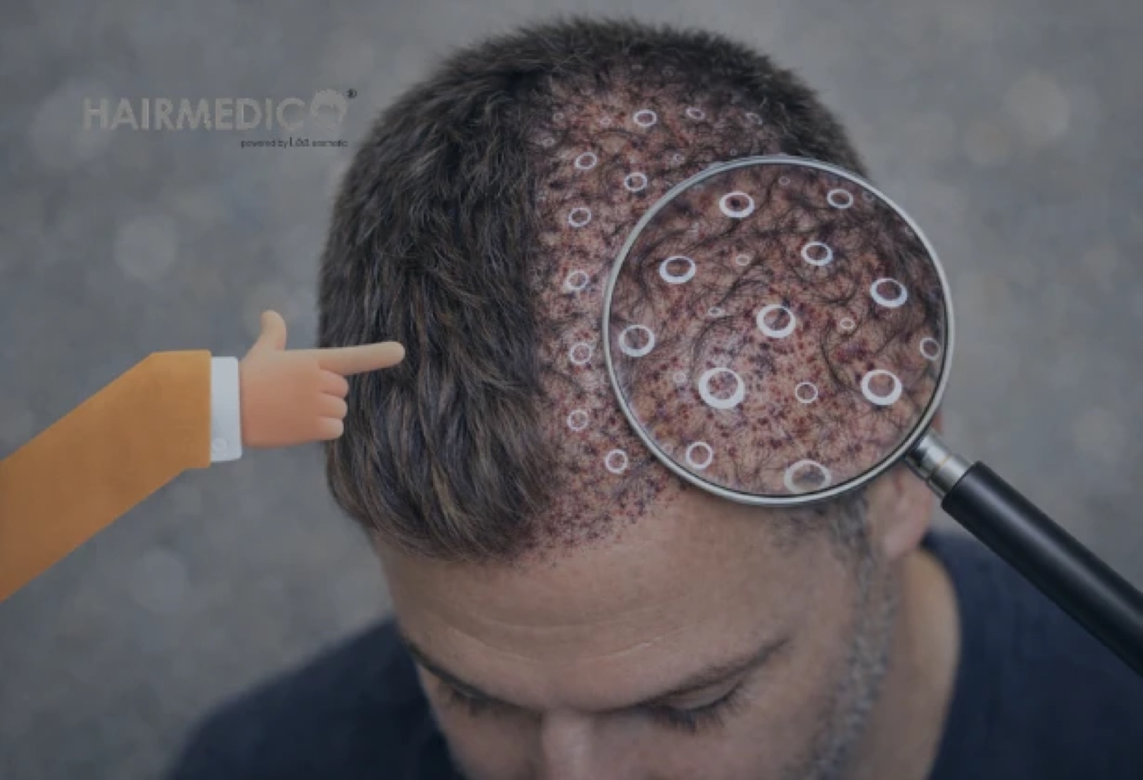 Hair Transplant Density vs Graft Count — Why...