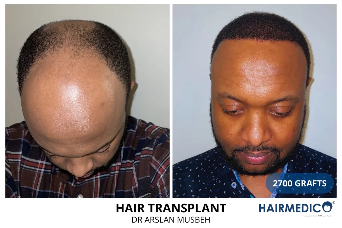 Hair transplant before and after — 2700