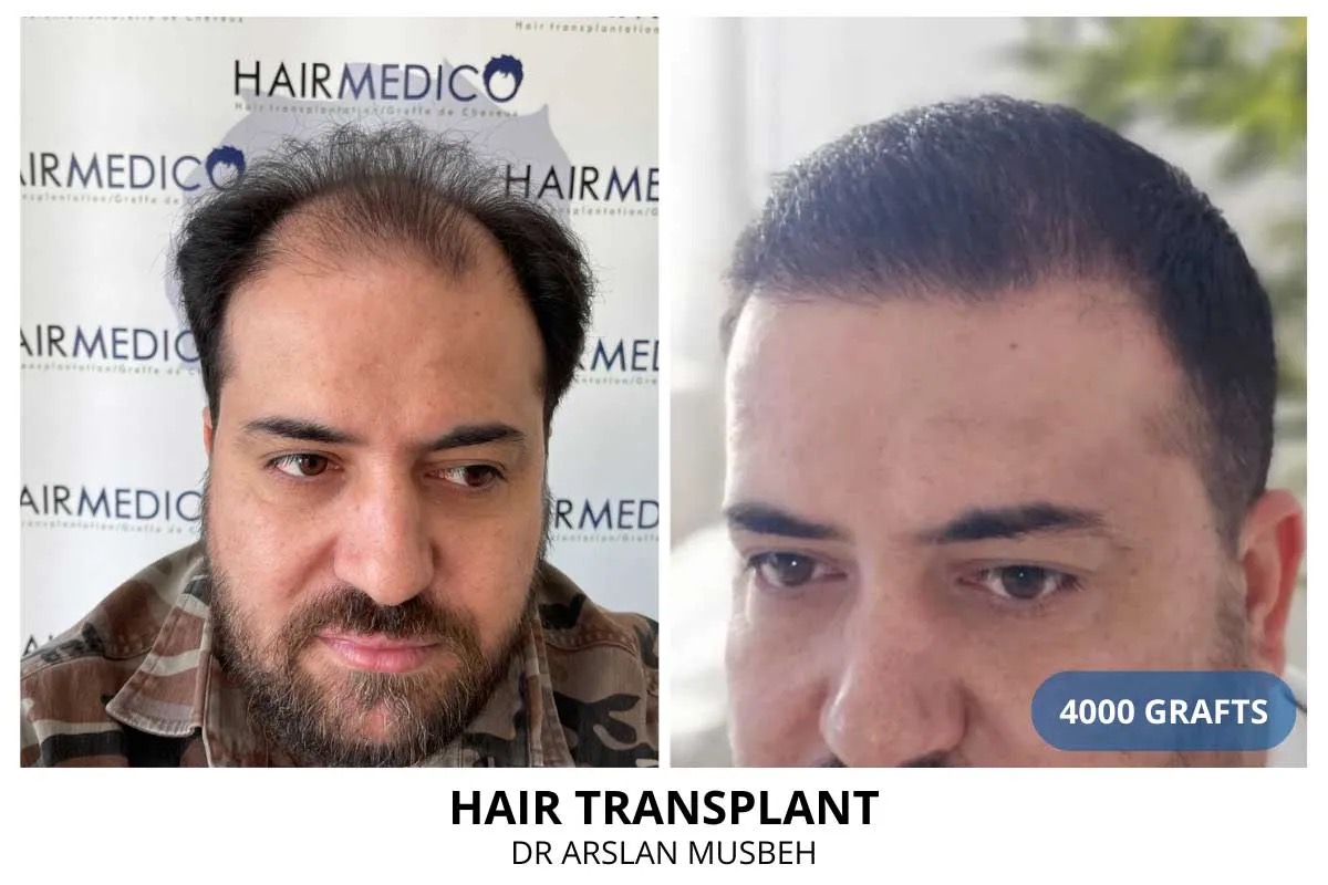 Hair transplant before and after — 4000