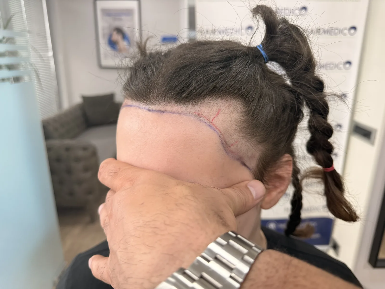 Hairline and donor area marking during pre-operative consultation before hair transplant surgery in Istanbul