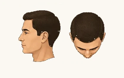 Norwood I — full hairline, no recession