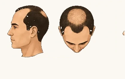 Norwood IV — significant recession with crown thinning