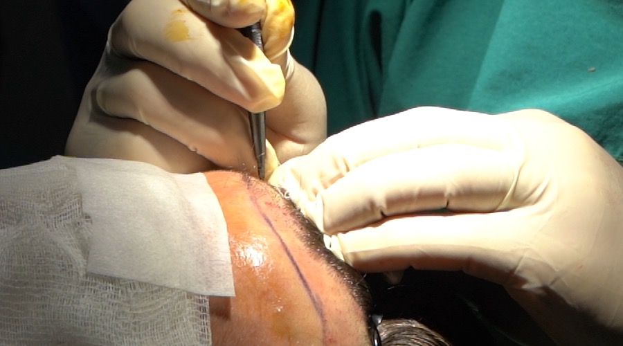 Hair transplant surgeon consultation and planning