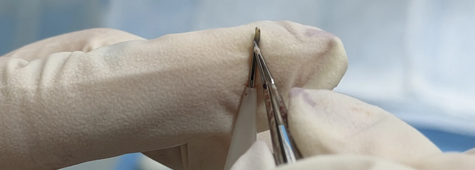 Close-up of graft handling during DHI implantation at Hairmedico