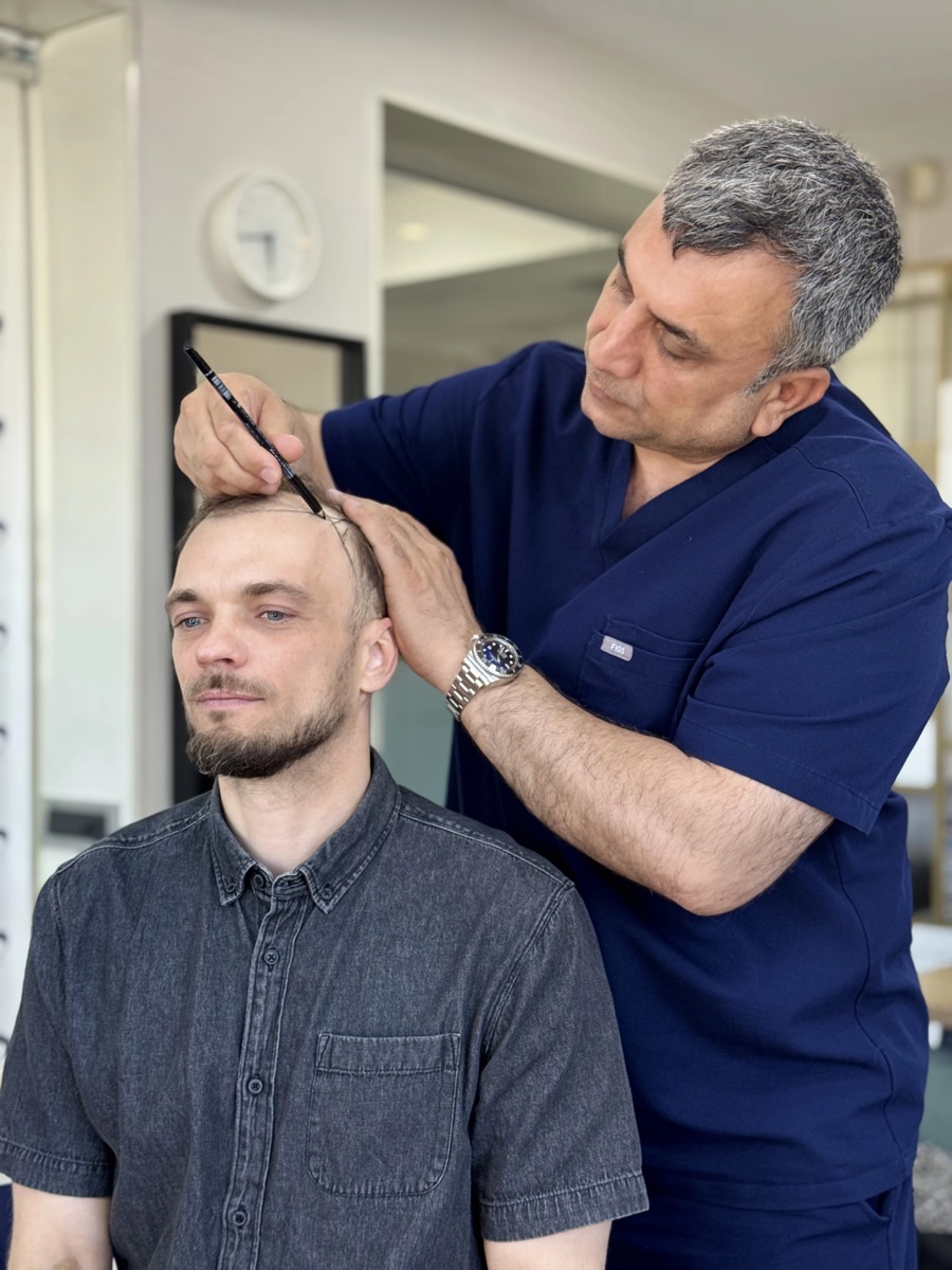 Dr. Arslan Musbeh marking the hairline before DHI implantation