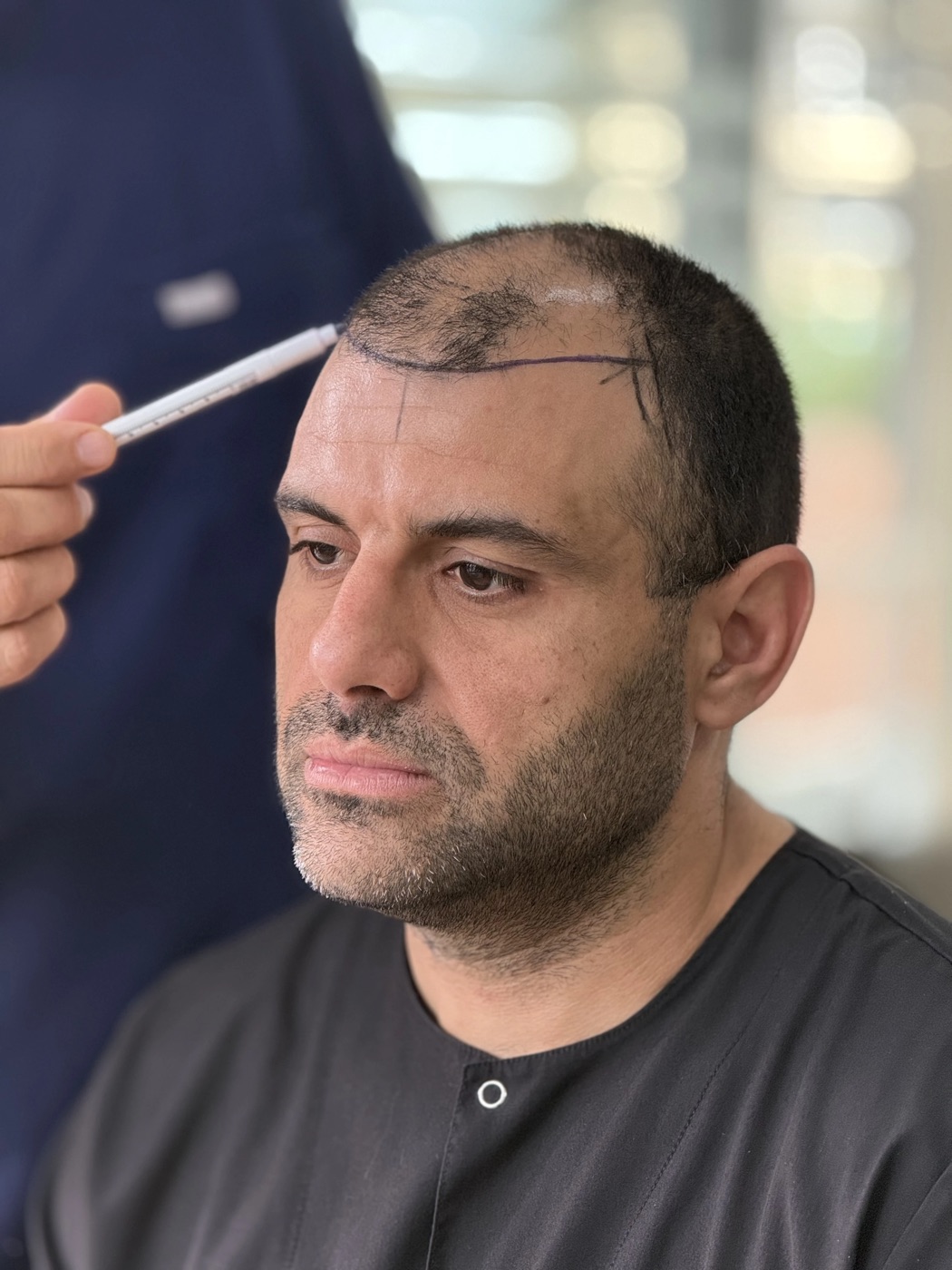 Dr. Arslan Musbeh marking a hairline design before surgery