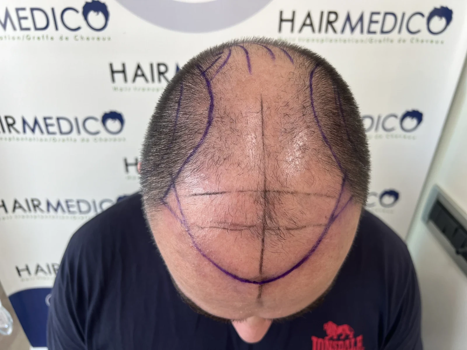 Top-down view of a patient's crown with the recipient area marked in surgical pen before a Hairmedico hair transplant