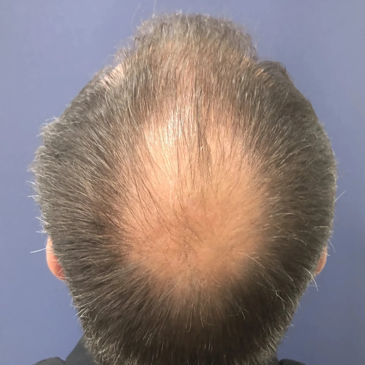 Crown thinning pattern assessed for hair transplant candidacy
