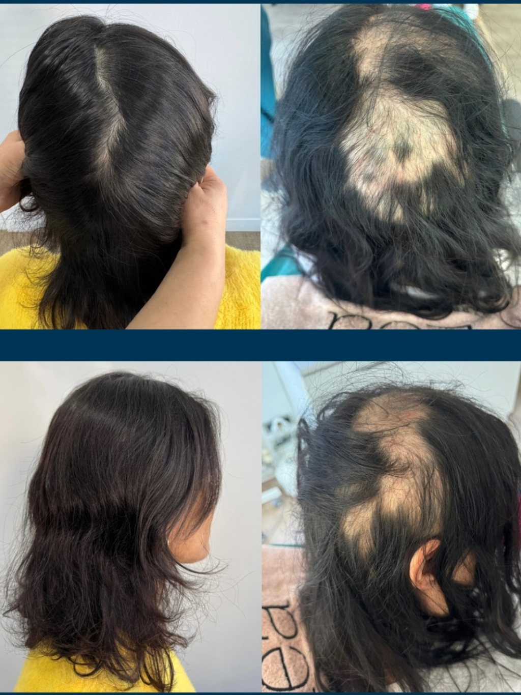 Alopecia areata patient before and after a PRP regrowth course at Hairmedico Istanbul
