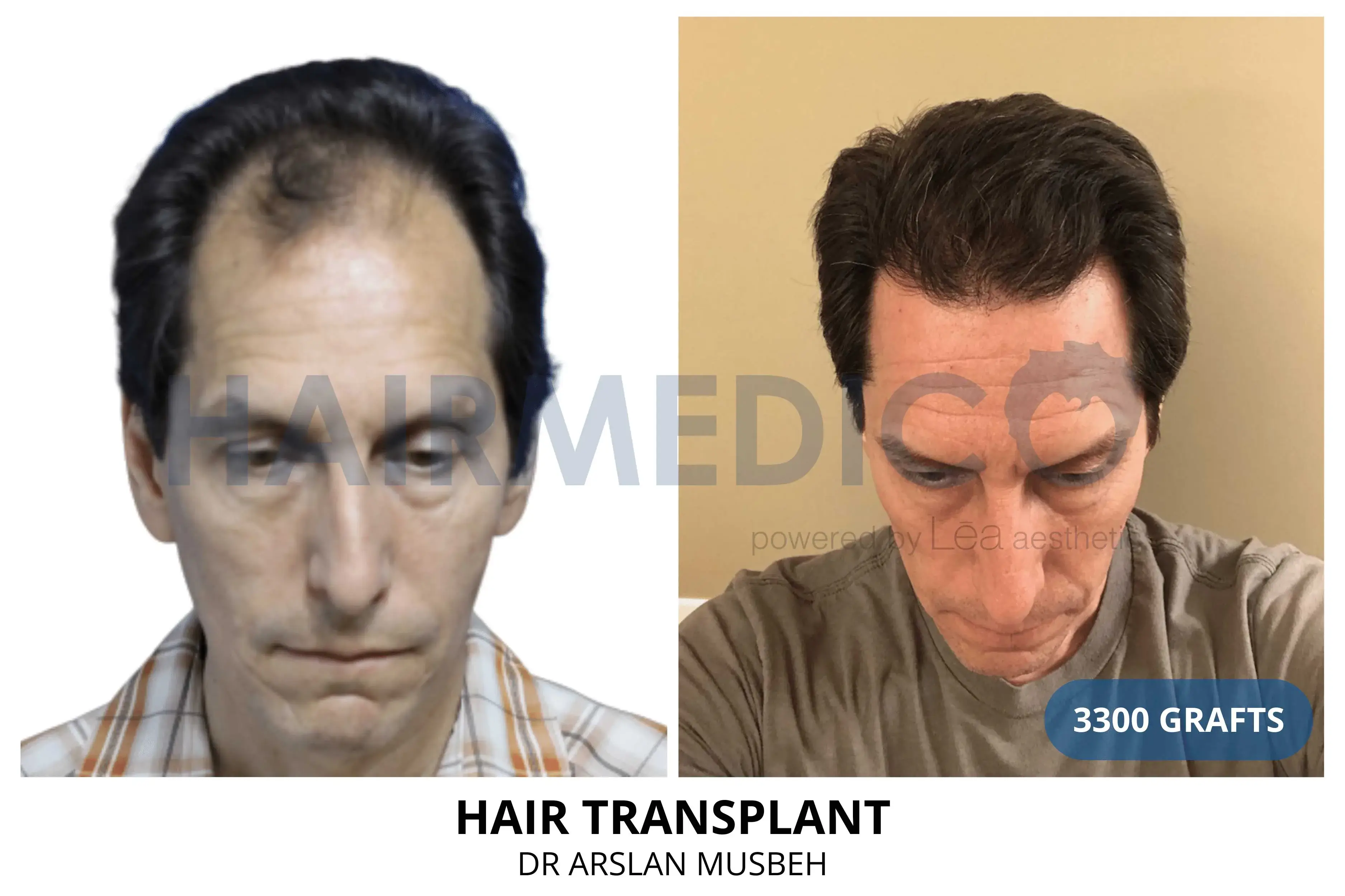 Hair transplant before and after result — 3,300 grafts, Dr. Arslan Musbeh, Hairmedico Istanbul