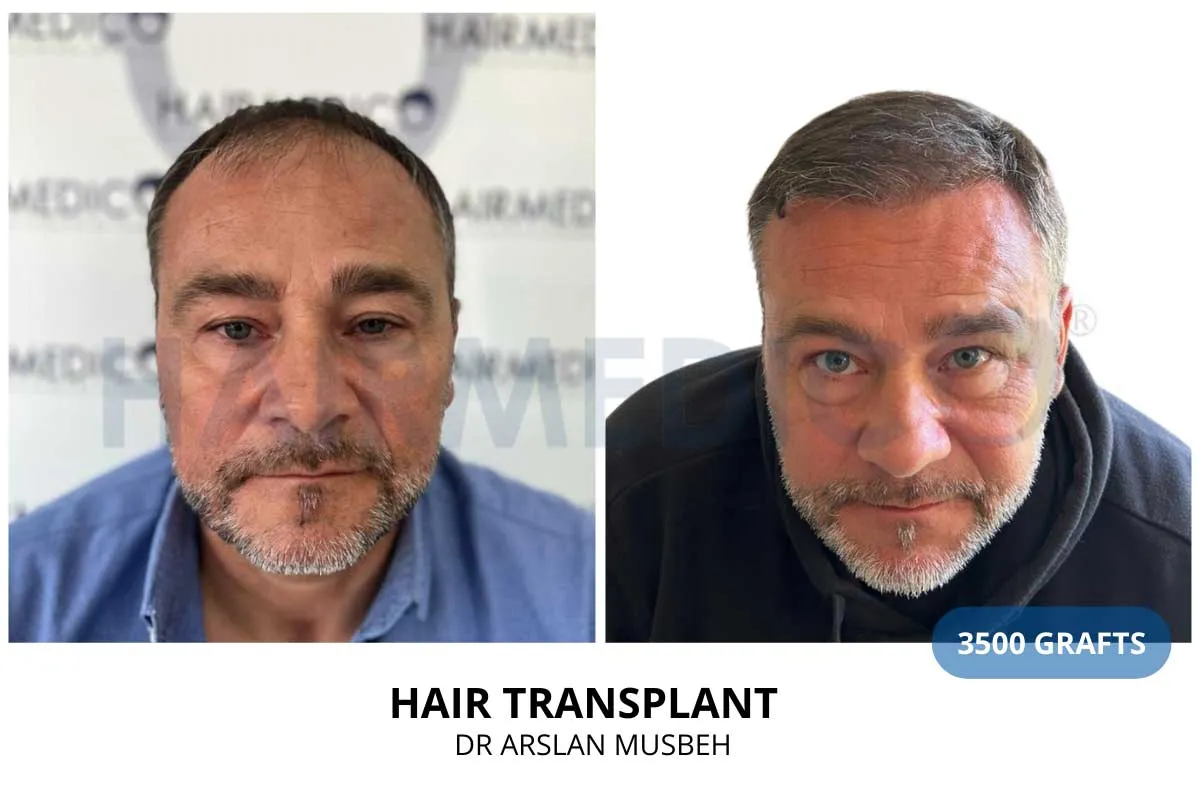 Hair transplant before and after result — 3,500 grafts, Dr. Arslan Musbeh, Hairmedico Istanbul