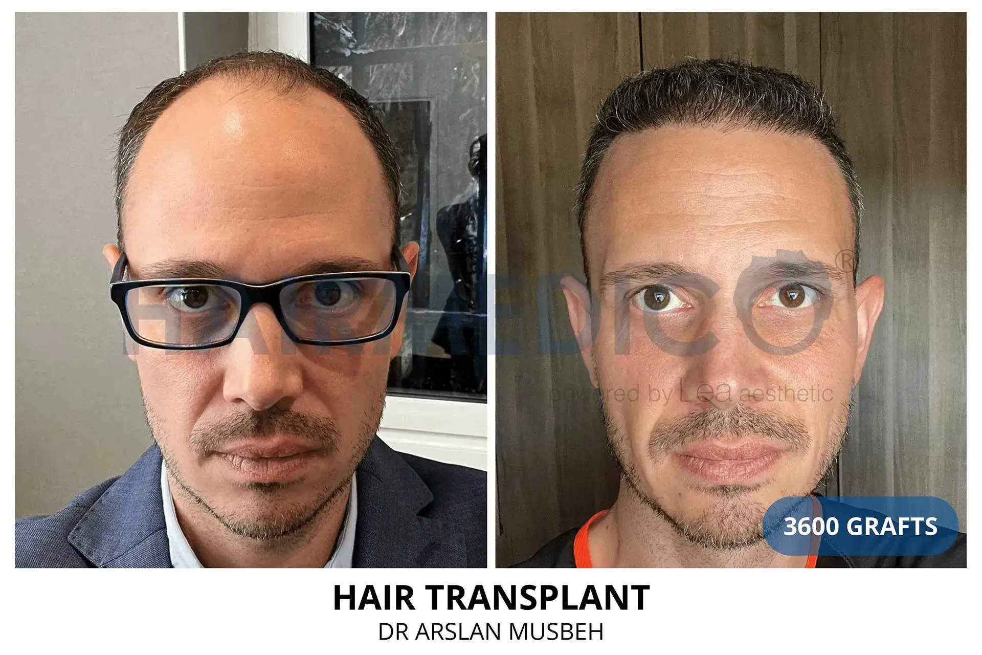 Hair transplant before and after result — 3,600 grafts, Dr. Arslan Musbeh, Hairmedico Istanbul