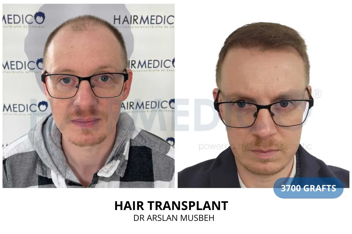 Hair transplant before and after result — 3,700 grafts, Dr. Arslan Musbeh, Hairmedico Istanbul